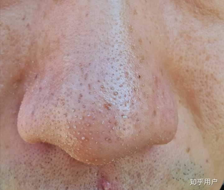 黑头到底是什么, 怎么产生的? - 知乎
