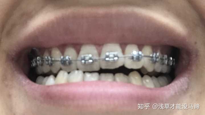 现在武大口腔医院成人正畸大概费用是多少 知乎