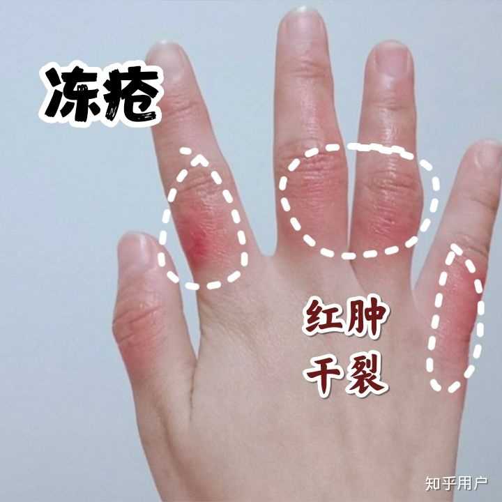 为什么每到冬天手背都会开裂？ - 知乎