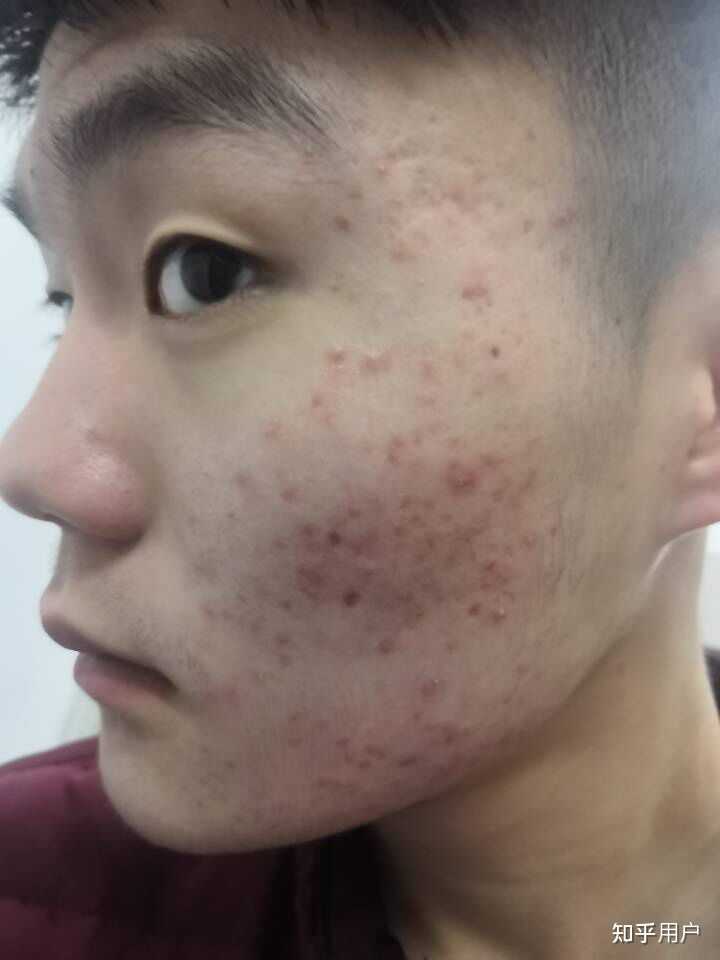痘印不要药多久会消失？ - 知乎