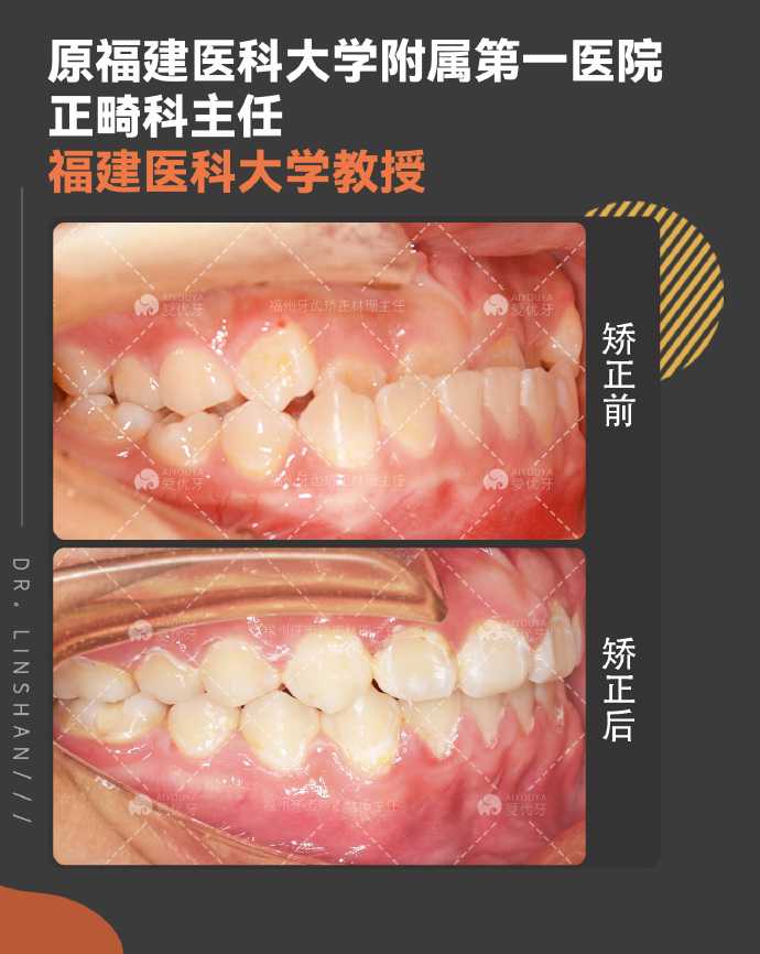 你的反颌(地包天)正畸矫正成功了吗? - 知乎