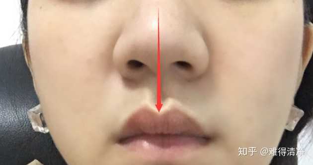 鼻子歪怎么办 知乎