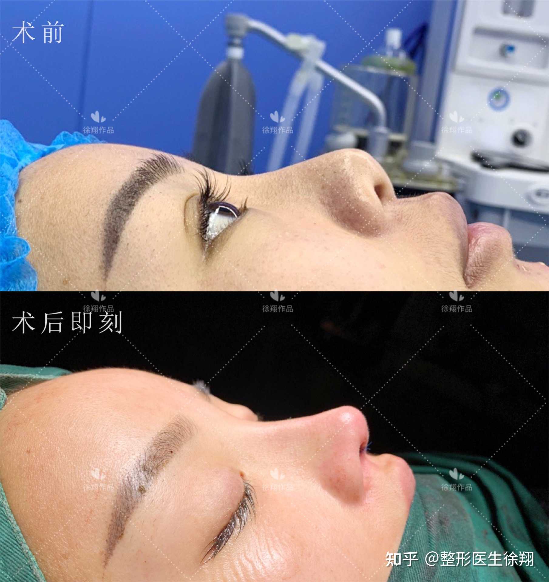 鼻综合案例分享