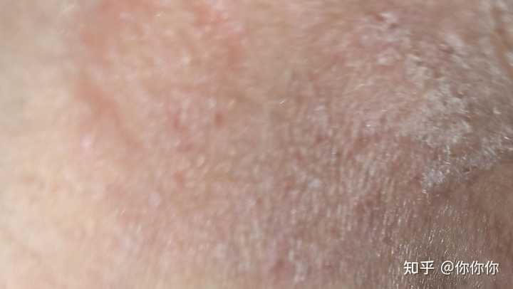 请问我这是股藓还是湿疹？（有图）？ 知乎 