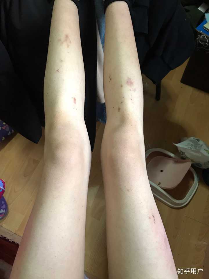 梨形身材的女孩子瘦下来腿会变细吗?