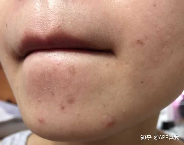 脸上一直长粉刺怎么办 知乎