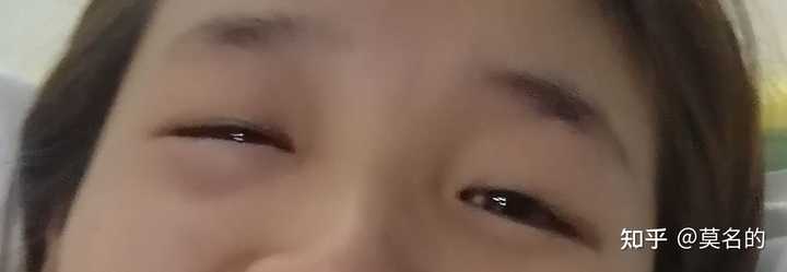下眼袋突然肿起来是什么回事 知乎