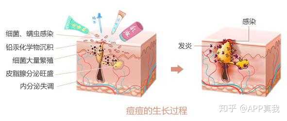痘印心得经验_痘印心得经验_痘印心得经验