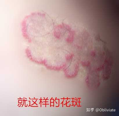 大腿内侧股藓发黑，但不痒，要怎么根治！？ 知乎 