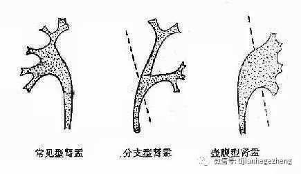 民航招飞季博士:招飞体检常见异常:壶腹型肾盂zhuanlan.zhihu.com文章