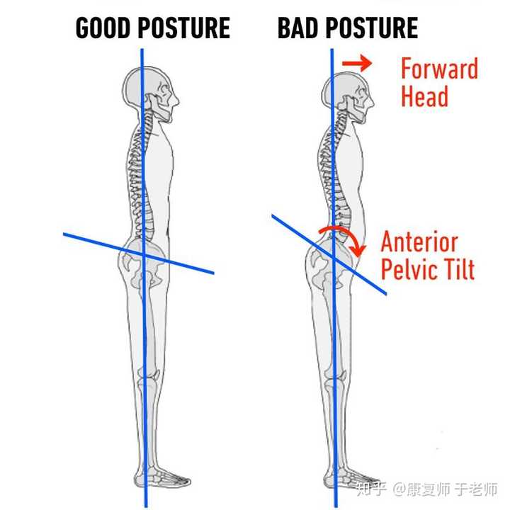 骨盆前倾有矫正成功的例子吗 知乎