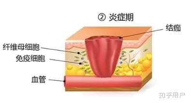 伤口愈合过程是怎样的? - 知乎