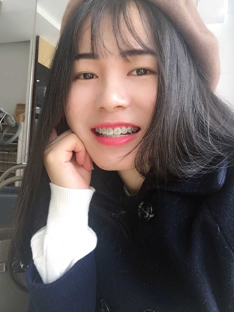 更新最近的进展啦之前门牙太挤,导致一颗磨损,另一颗正常,所以拍照是