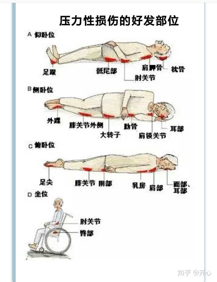 长期卧床的老人需要哪些护理？ - 知乎