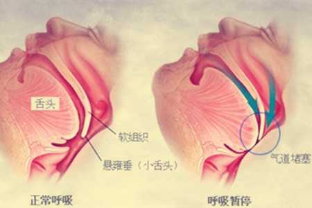 如何快速治疗打呼 v2-7a1423bbce8c29c9970ec6250022bc55_bh.jpg