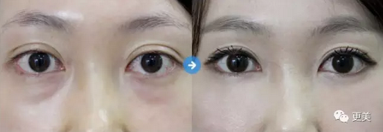 什么是 卧蚕 它跟眼袋有什么区别 知乎