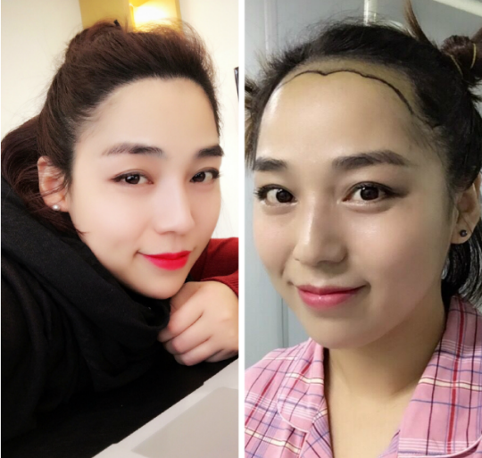 秃额角,发际线 高,适合什么发型?