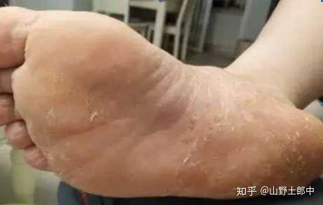 我本身就是汗腳,再加上膠鞋不透氣,所以就.