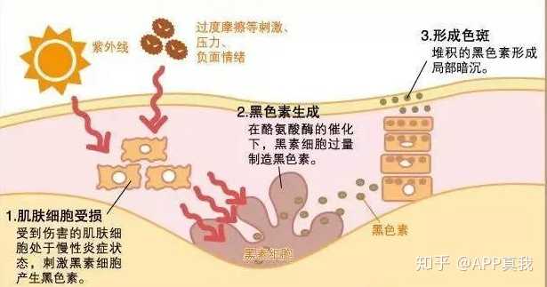 痘印心得经验_痘印的烦恼_痘印的解决方法