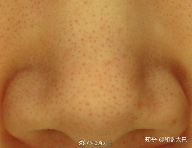 如何正确有效的去掉鼻子上的黑头 知乎
