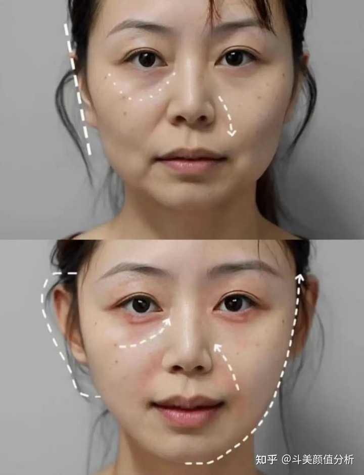 童颜针到底是什么？有什么作用？ - 知乎