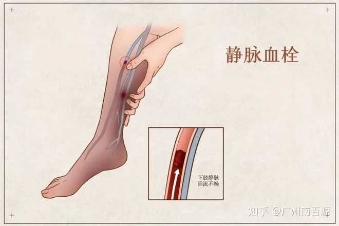 坏死，梗死，血栓形成，血栓，栓塞，栓子这几个之间的区别与联系? - 知乎