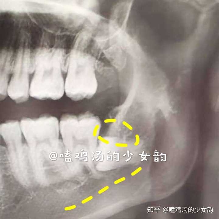 這是賴著我不肯走的那顆智齒,幾乎沒有做手術的空間