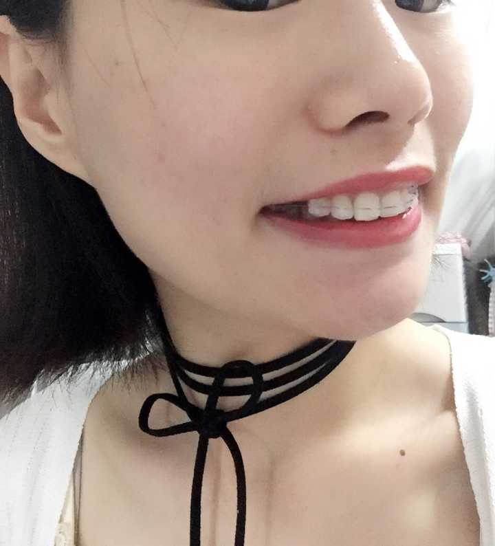 牙根短可以正畸吗,风险大吗?