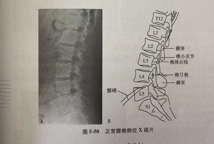 正常腰椎x光片图 讲解图片