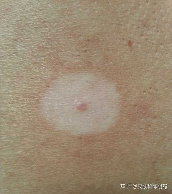 晕痣是什么疾病吗