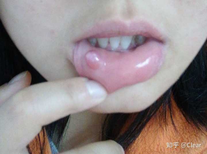 嘴唇粘液腺囊肿手术后？