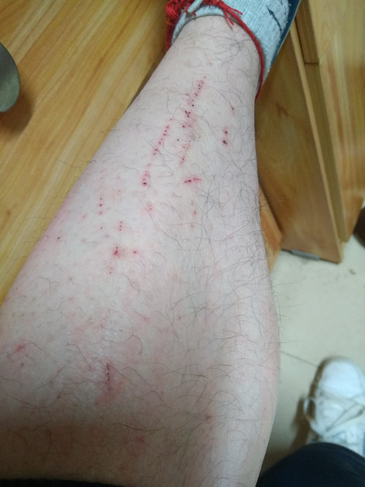 想请问为什么小腿无缘无故长血痂? - 知乎