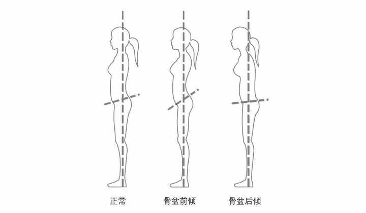 如何锻炼改善骨盆前倾 知乎