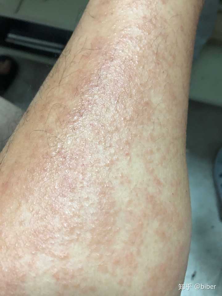 孕妇湿疹怎么办 知乎 孕妇湿疹怎么办 知乎