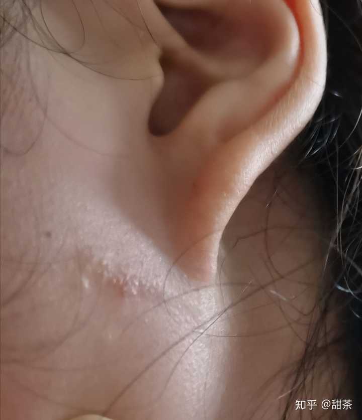 换了一个新地方上学然后脸颊两侧耳朵下面长了一道有小疙瘩的肿痕很痒