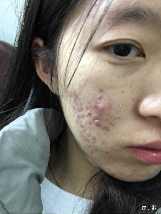 为什么针清容易留坑 医院皮肤科还要针清？ - 知乎