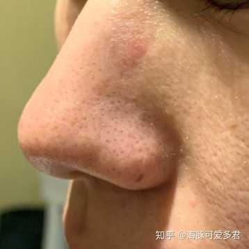 男士如何去黑头 知乎