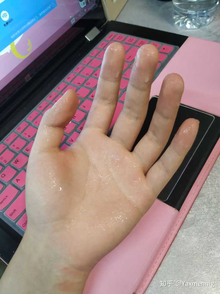 手出汗出的非常厉害是怎么一回事,好多年了?