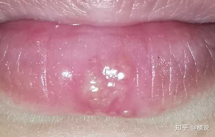 嘴角起泡如何处理可以最短时间痊愈 知乎 嘴角起泡如何处理可以最短时间痊愈 知乎
