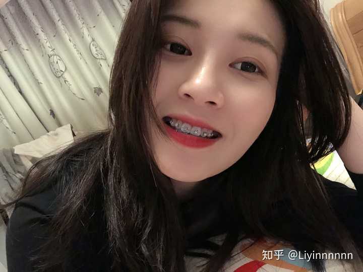 女孩子带牙套是不是很难看?