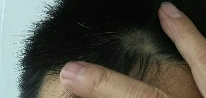 斑秃怎么办 知乎 斑秃怎么办 知乎