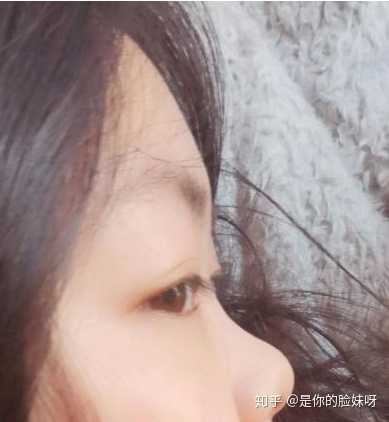 隆鼻会有什么后遗症吗 是你的脸妹呀的回答 知乎