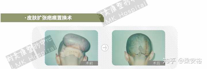 什么情况下需要植皮？ - 知乎