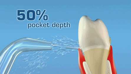 溅射水柱对牙周袋的冲洗作用