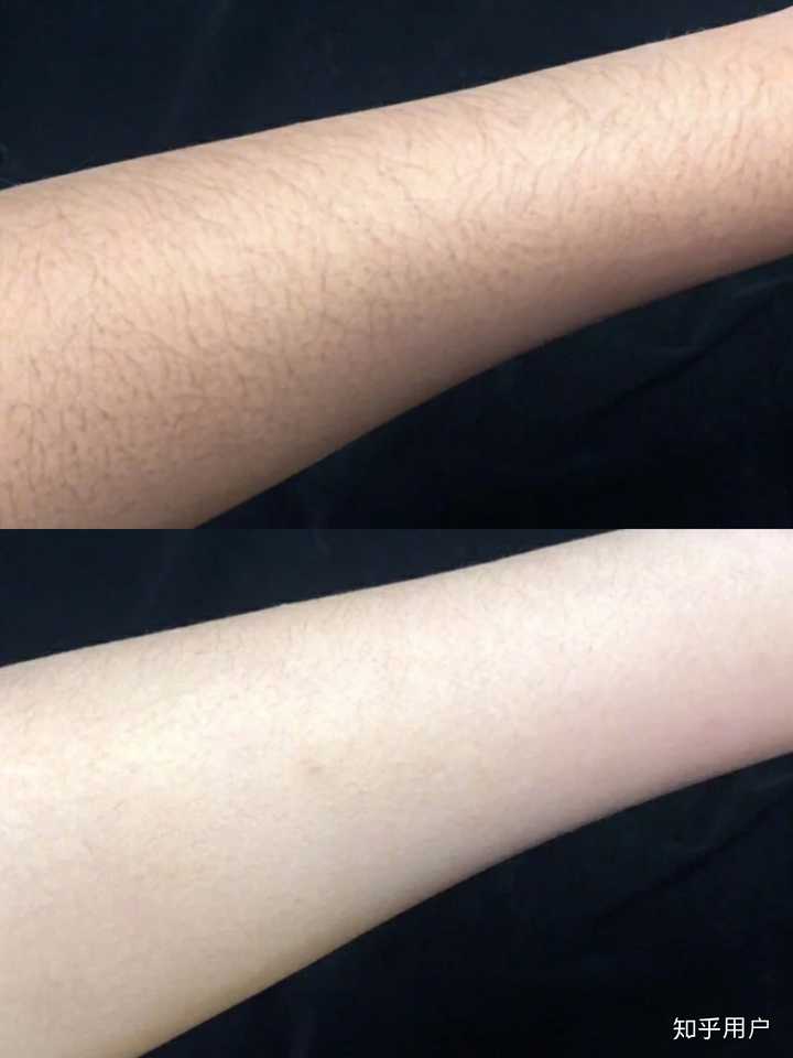 激光脱毛后有色沉该怎么办 知乎 激光脱毛后有色沉该怎么办 知乎
