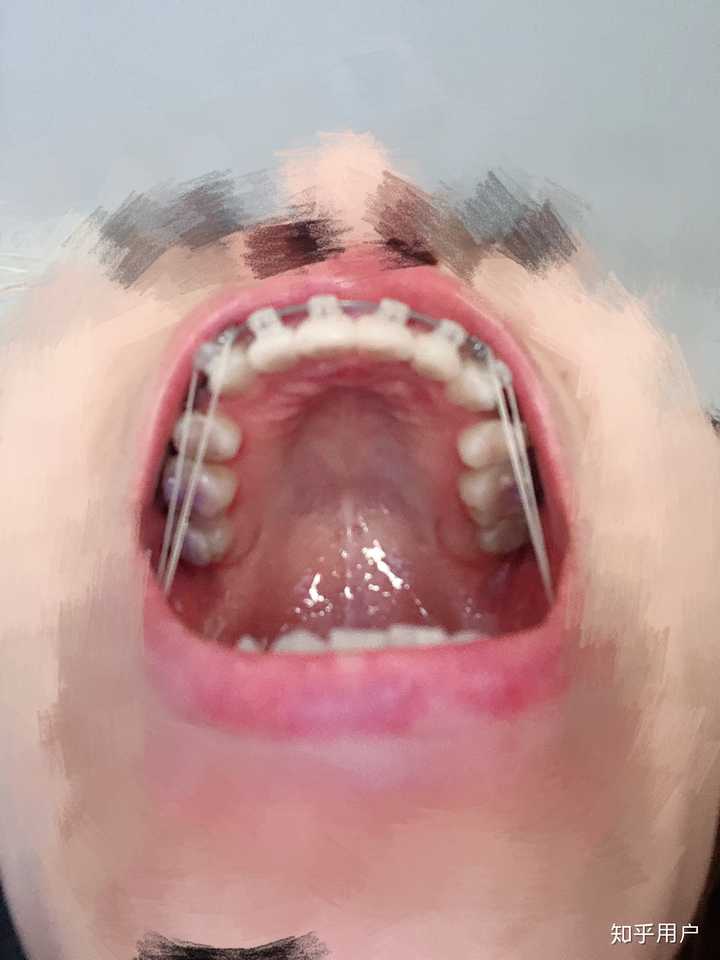做正颌手术是怎样的体验？