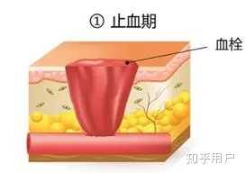 伤口愈合过程是怎样的? - 知乎