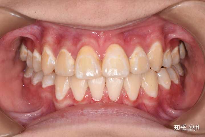 摘牙套后会留下印记吗就是一个一个小方块的样子