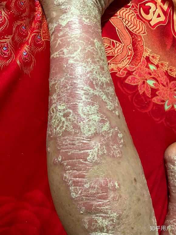 我之前的牛皮癣四年多,然后治好了,结果17年年底就 因为吃了炖火锅