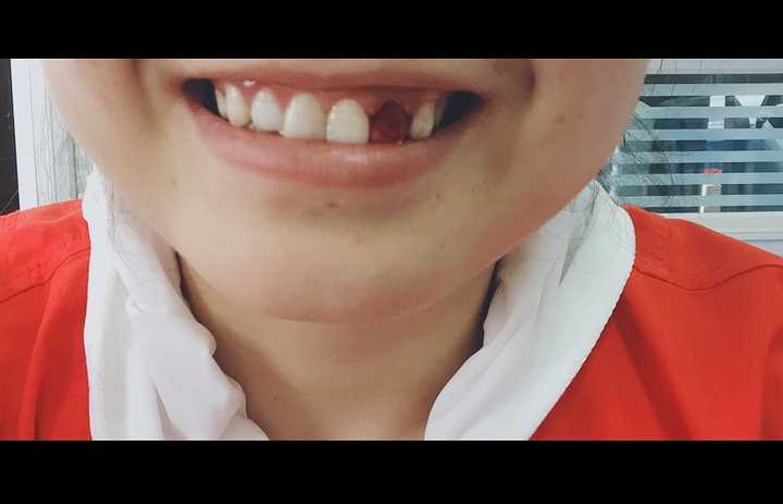 洗牙以后不停流血 张开嘴就是血 怎么止血 知乎 洗牙以后不停流血 张开嘴就是血 怎么止血 知乎
